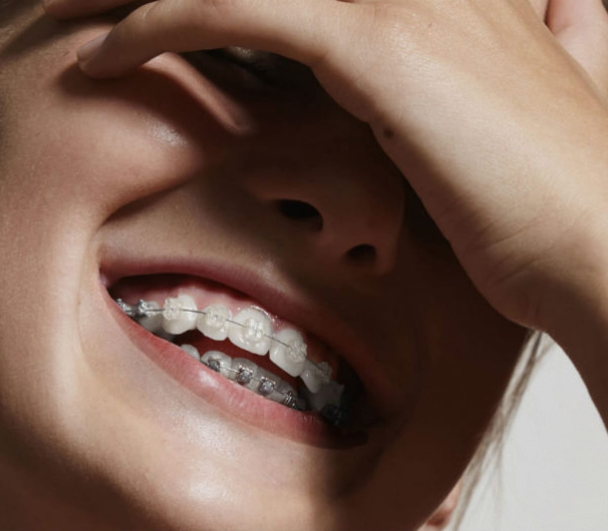 Ceramic Braces in New Paltz & Kerhonkson, NY - Dr. Pink Orthodontics