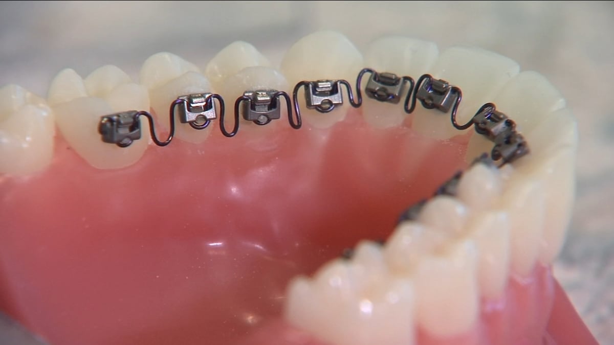 InBrace (Lingual) Braces in New Paltz & Kerhonkson, NY - Dr. Pink Orthodontics