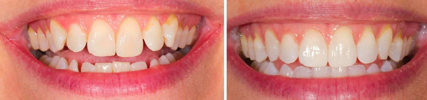 "Before and after image showing the closing of teeth gaps with clear aligners, resulting in a straighter, more uniform smile.