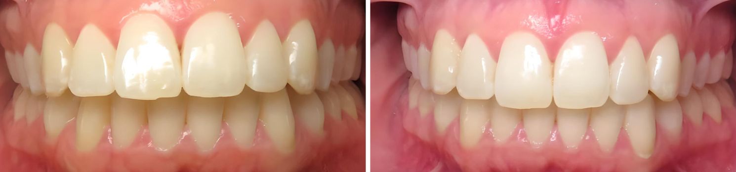 Before and after image of overbite correction using clear aligners, showing improved bite alignment and a more balanced smile.