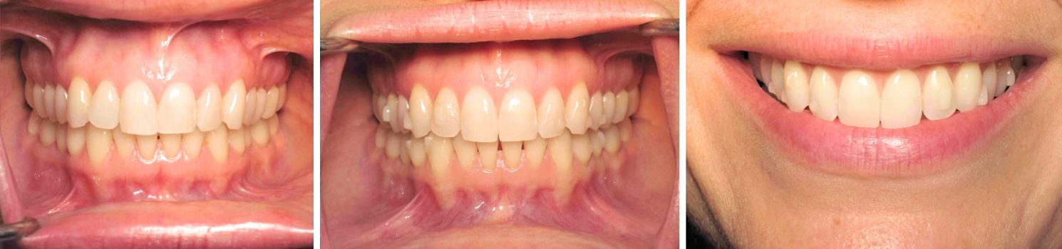 Before and after image showing three stages of clear aligner treatment, illustrating the progress from misaligned teeth to a straight, balanced smile.